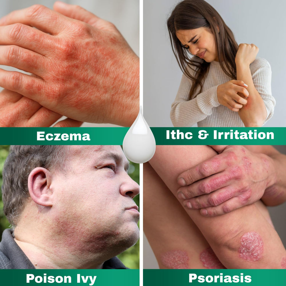 Hand applying Barmicil Plus to irritated skin.