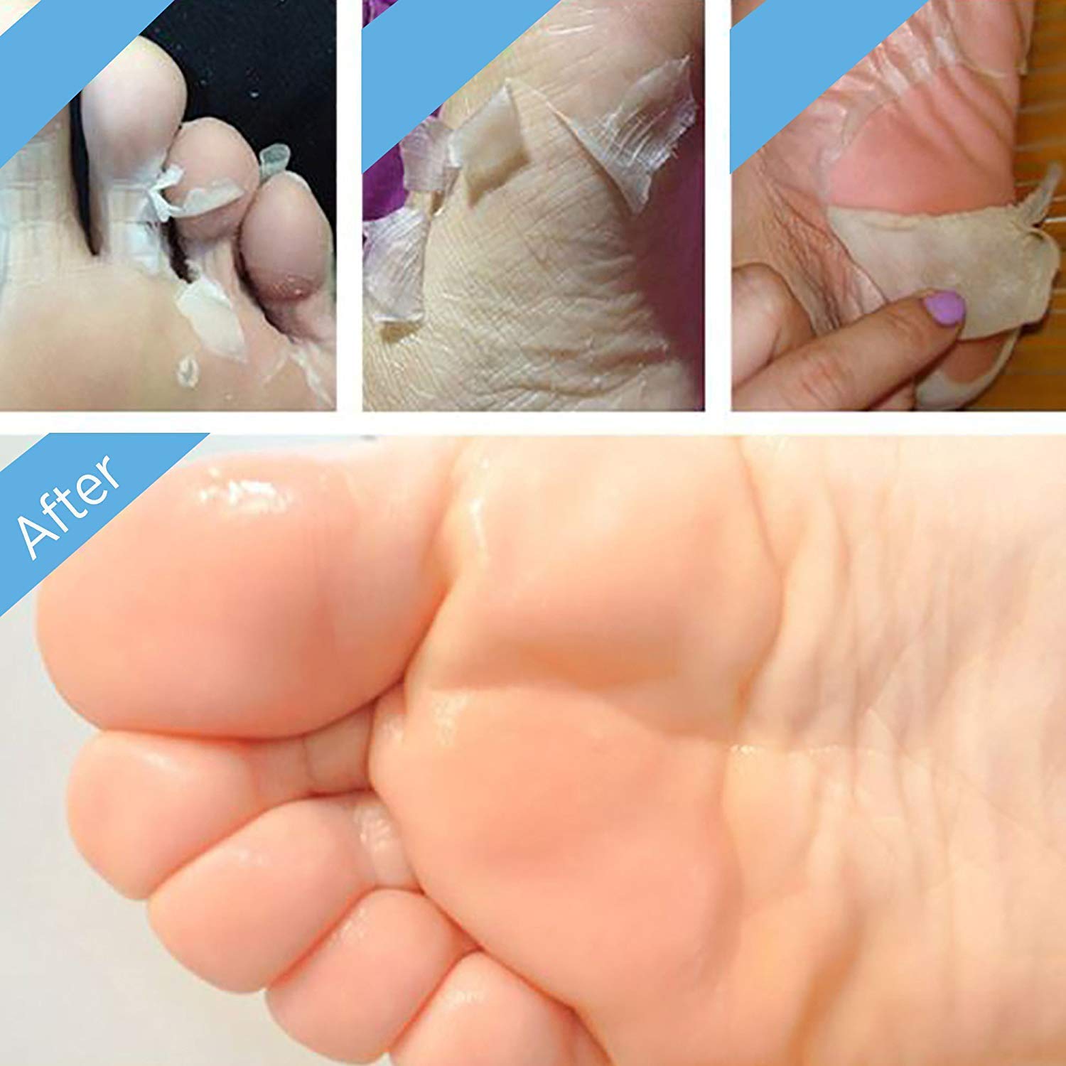 Bealuz peeling progress over days indicating dead skin removal