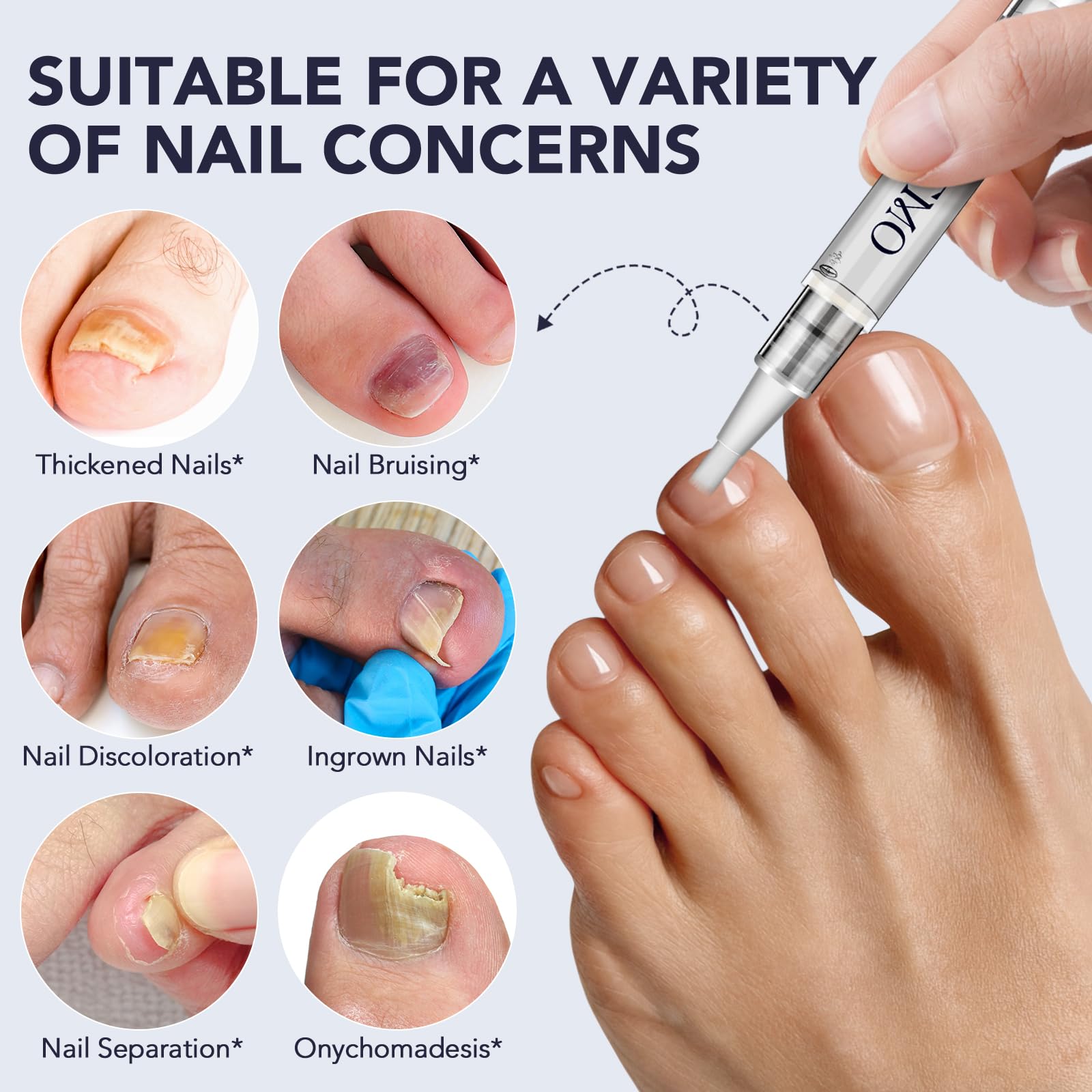 BXRUIAGN 25% undecylenic acid strengthens damaged nails.