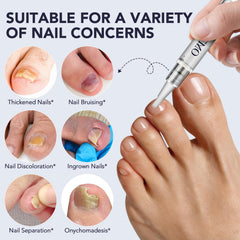 BXRUIAGN 25% undecylenic acid strengthens damaged nails.