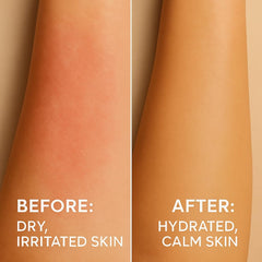 by.H sunburn relief application after sun exposure for soothing comfort.
