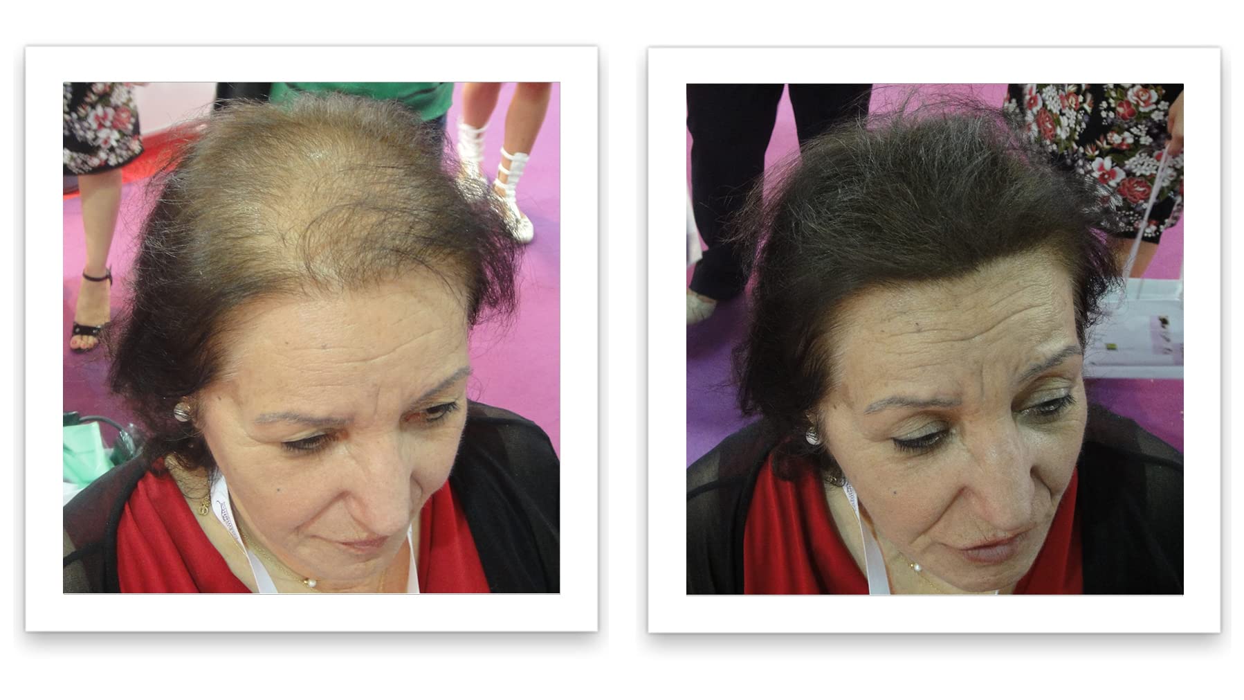 Caboki fibers applied to thinning crown for thicker appearance