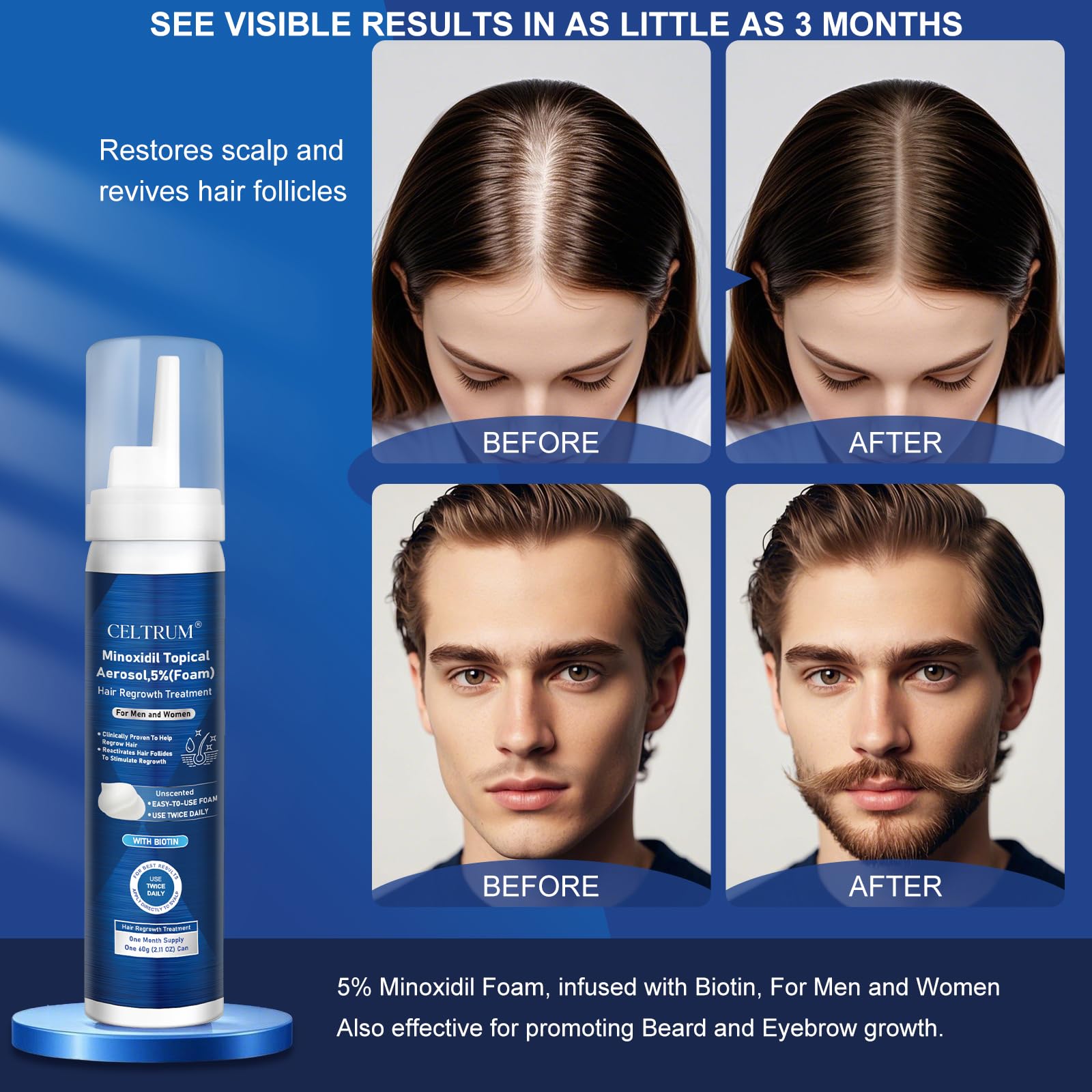 Celtrum Minoxidil Foam beard use supports fuller-looking facial hair.