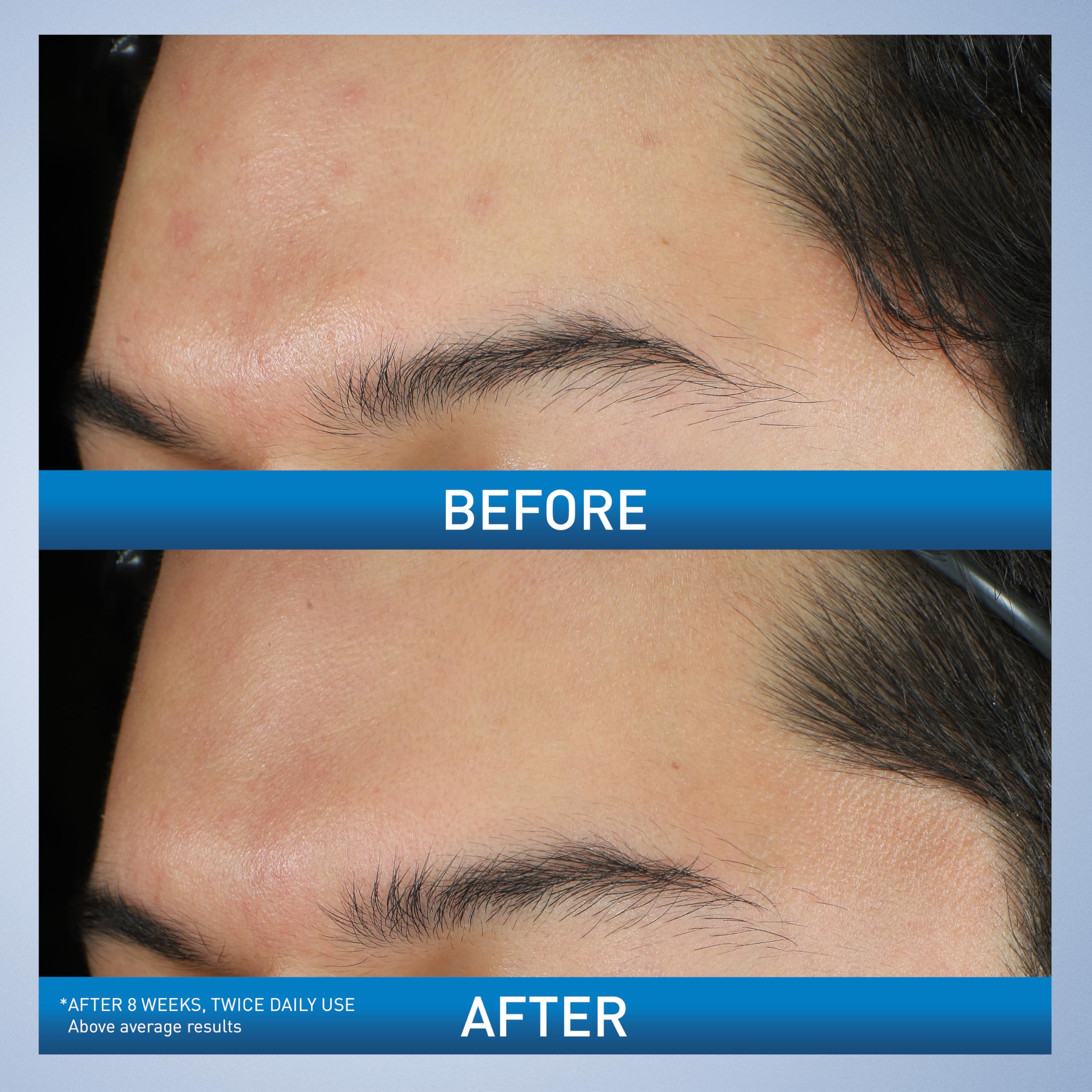 Label highlights 10% benzoyl peroxide for acne treatment
