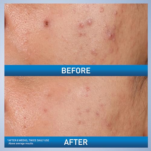 CeraVe Acne Control Gel with glycolic acid for smoother skin.