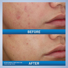 CeraVe Acne Foaming Cream Wash lathers into light foam during massage