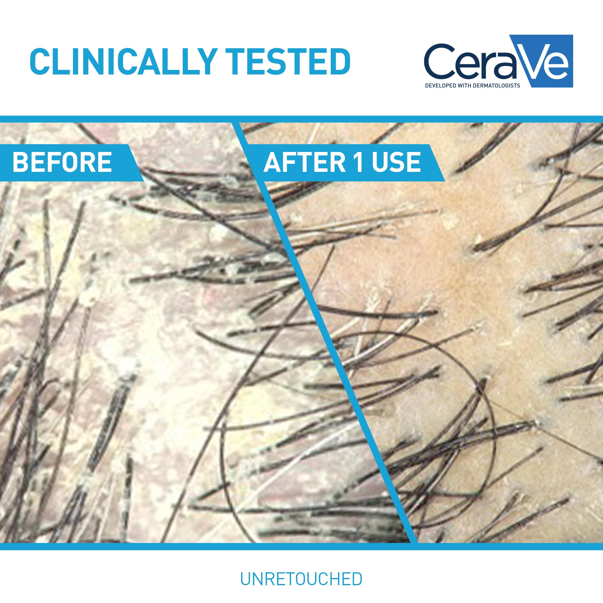 CeraVe pyrithione zinc dandruff treatment applied to scalp for visible flakes reduction.