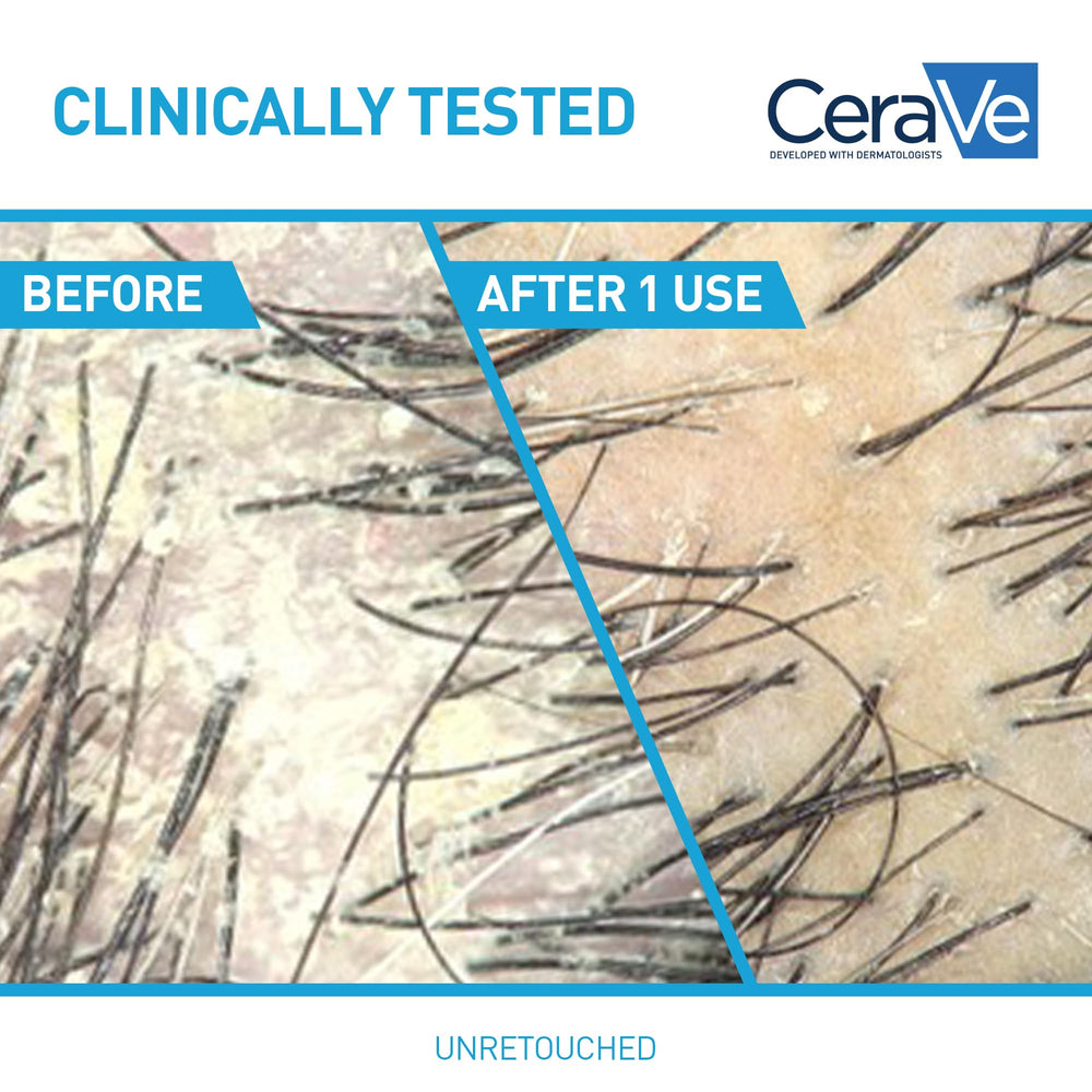 CeraVe pyrithione zinc dandruff treatment applied to scalp for visible flakes reduction.