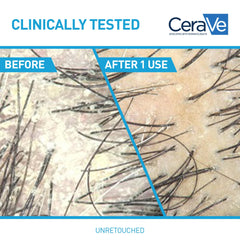 CeraVe pyrithione zinc dandruff treatment applied to scalp for visible flakes reduction.