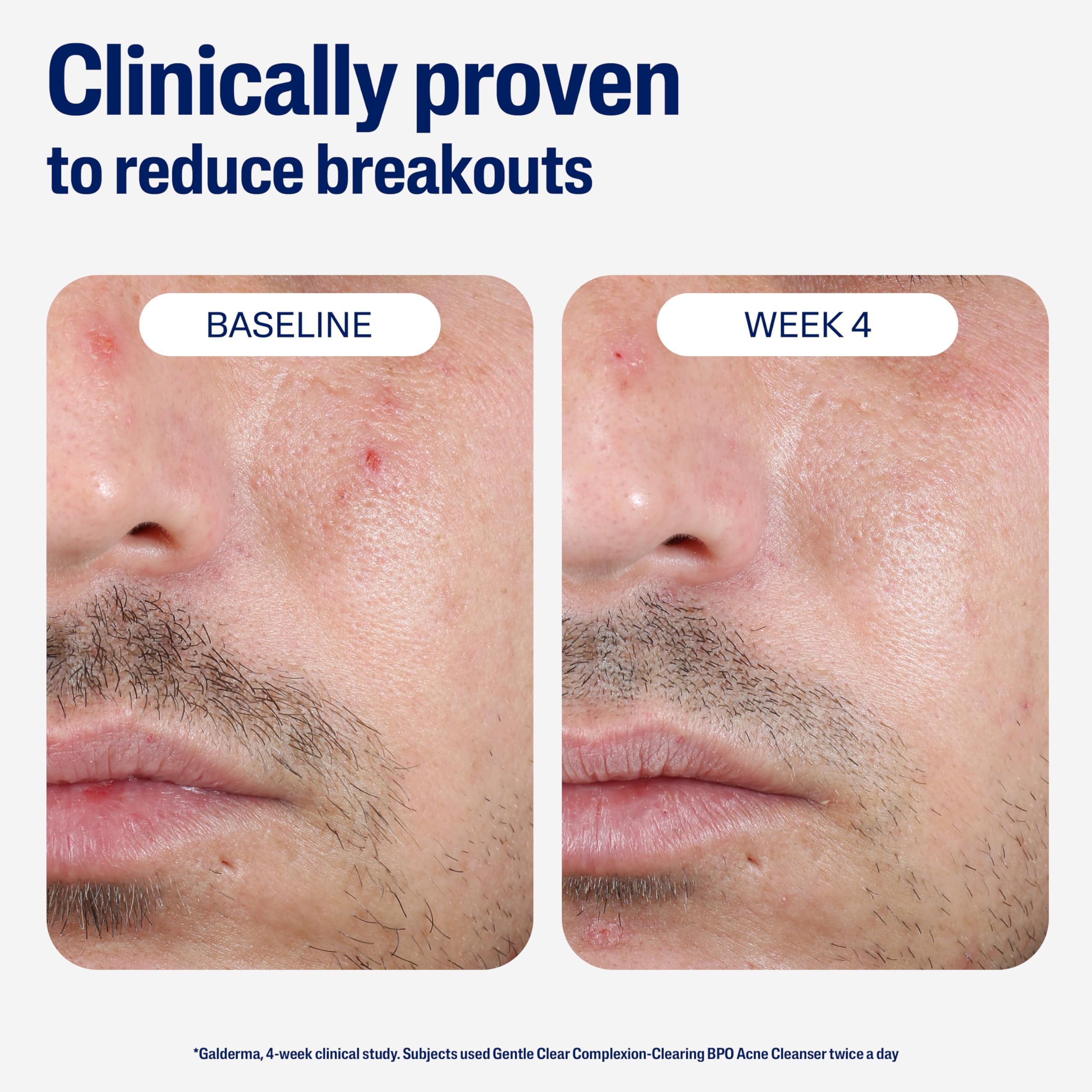 Cetaphil Gentle Clear supports oil balance in busy days
