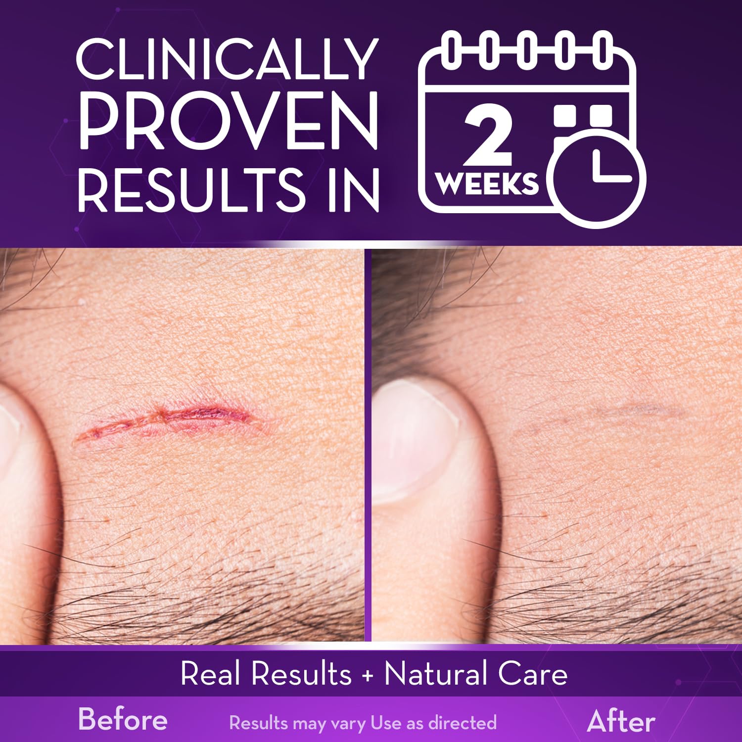 Cicatricure Advanced Scar Gel packaging with two tubes for home use.