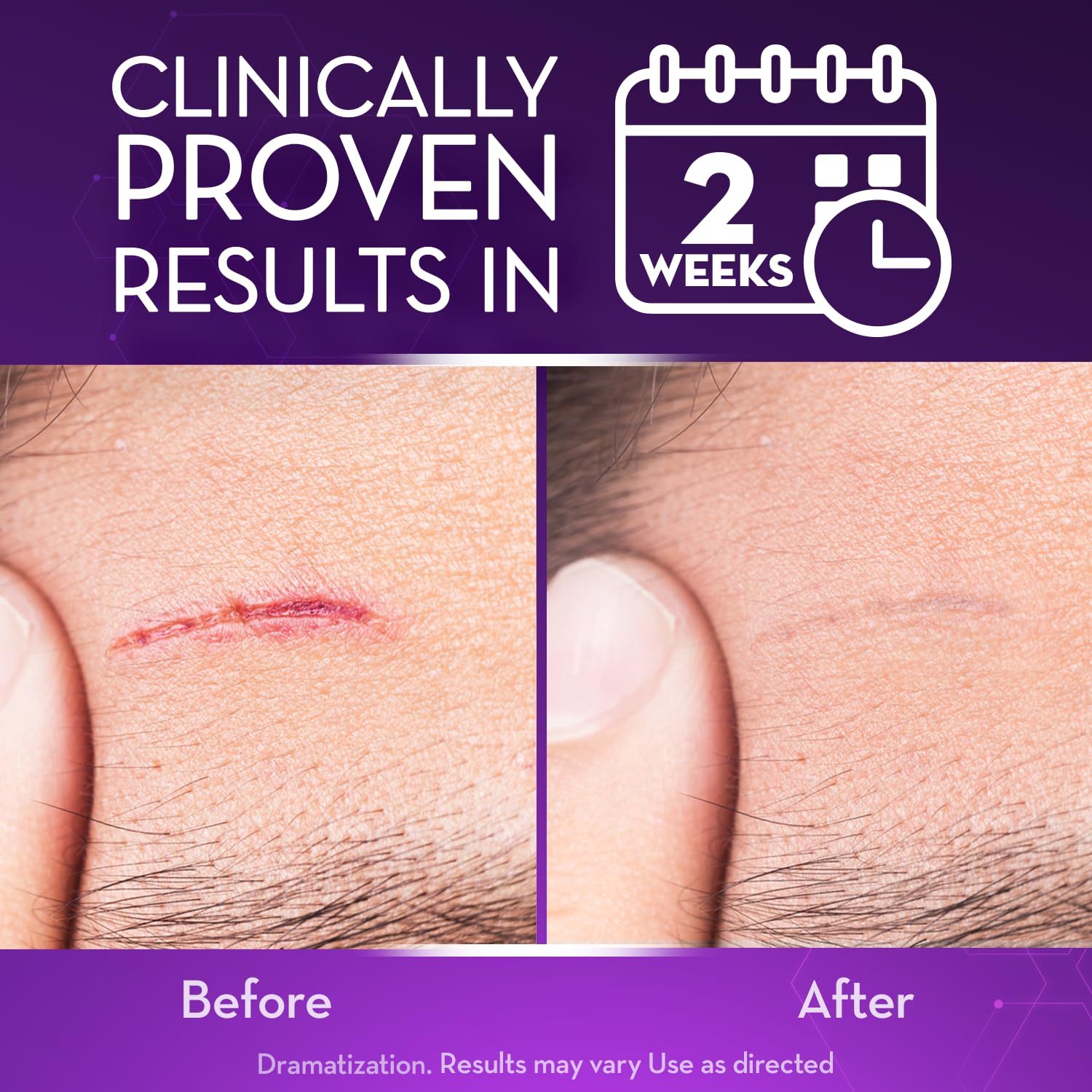 Cicatricure Advanced Scar Gel used on surgical scars to encourage even skin tone.