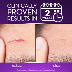 Cicatricure Advanced Scar Gel used on surgical scars to encourage even skin tone.