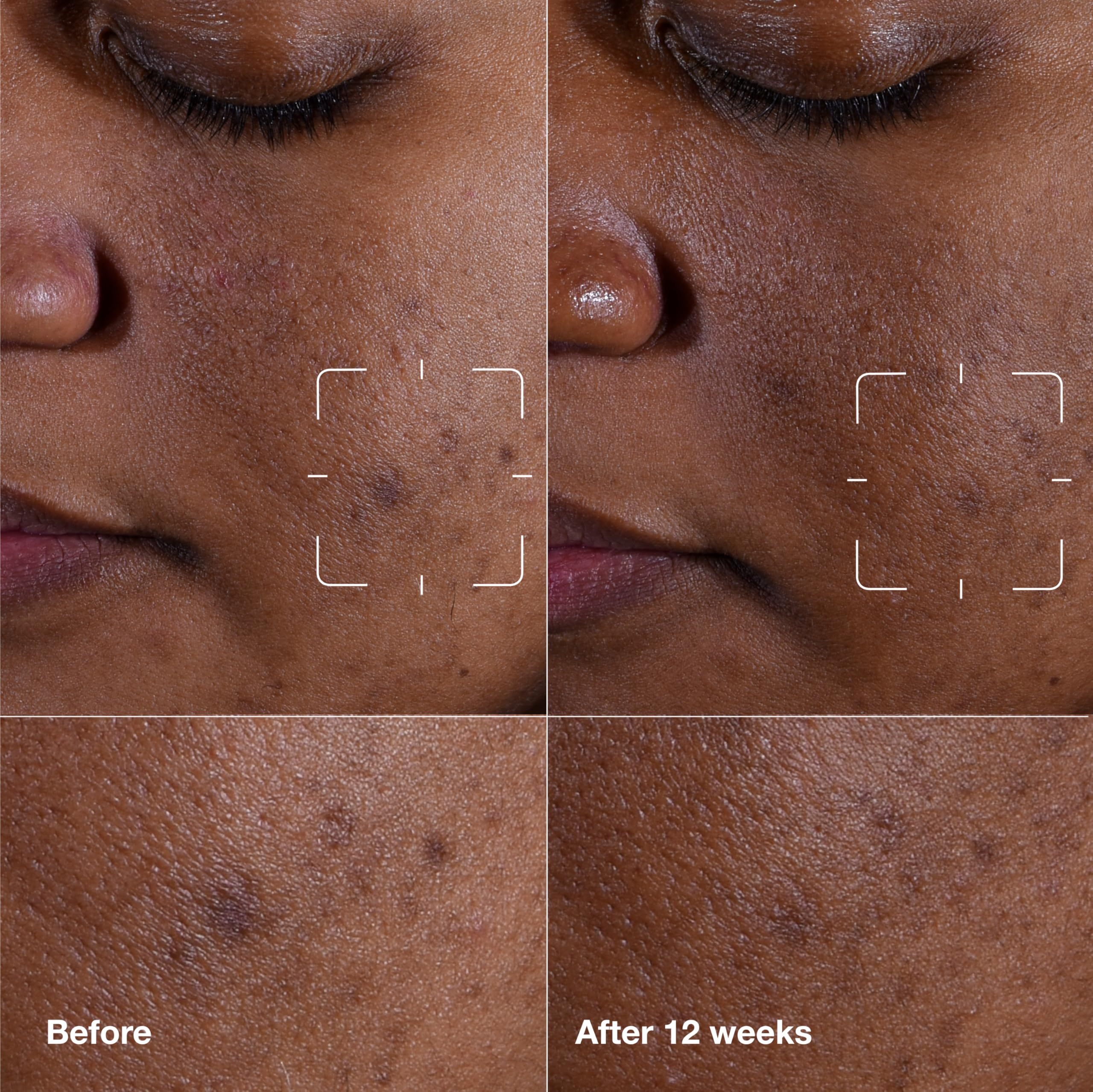 Clinique Even Better serum dropper on palm ready for precise application and fast absorption.