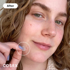 COSRX Acne Pimple Patch three-size pack for diverse blemishes