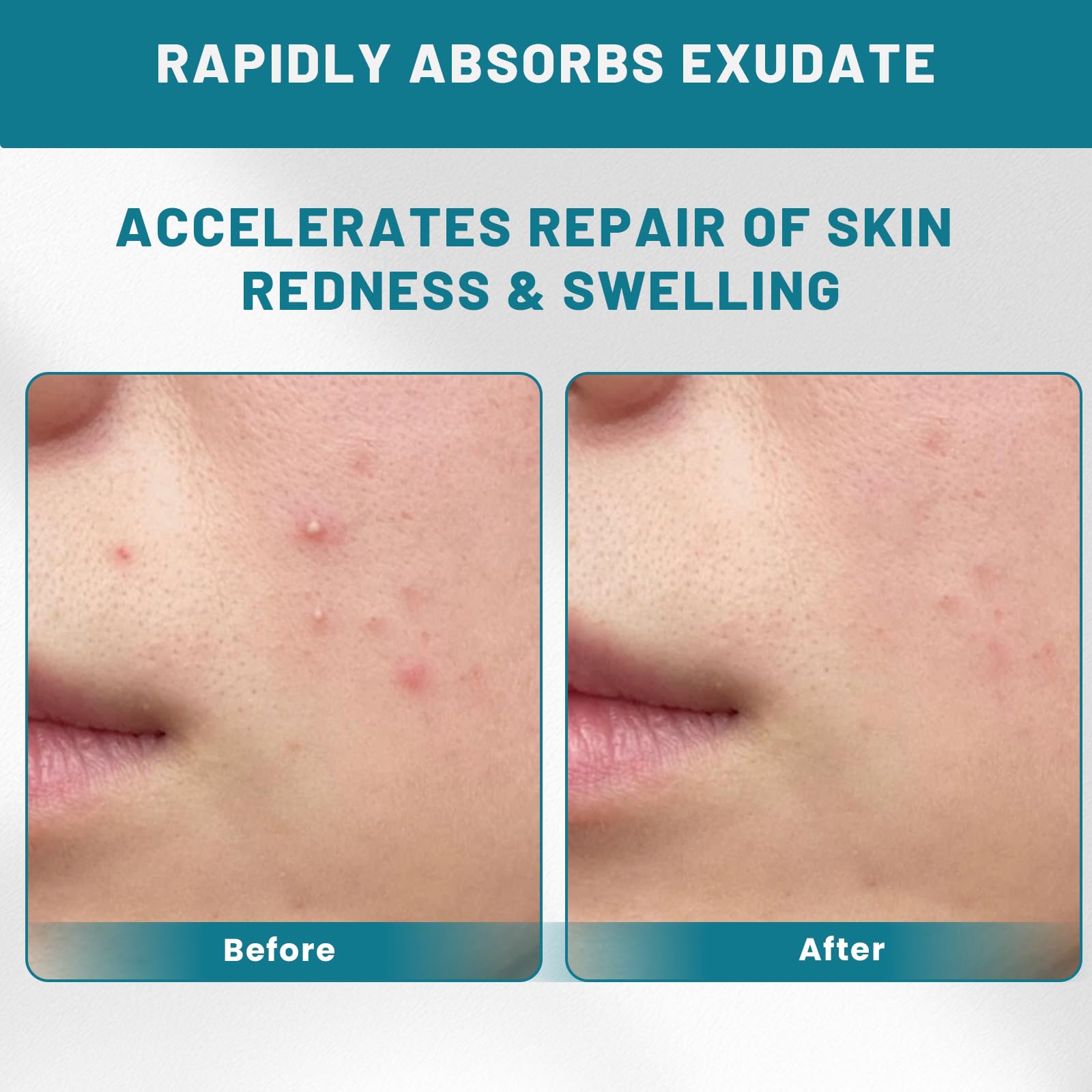 CUKWUYBY daily acne treatment patches support a clearer look.