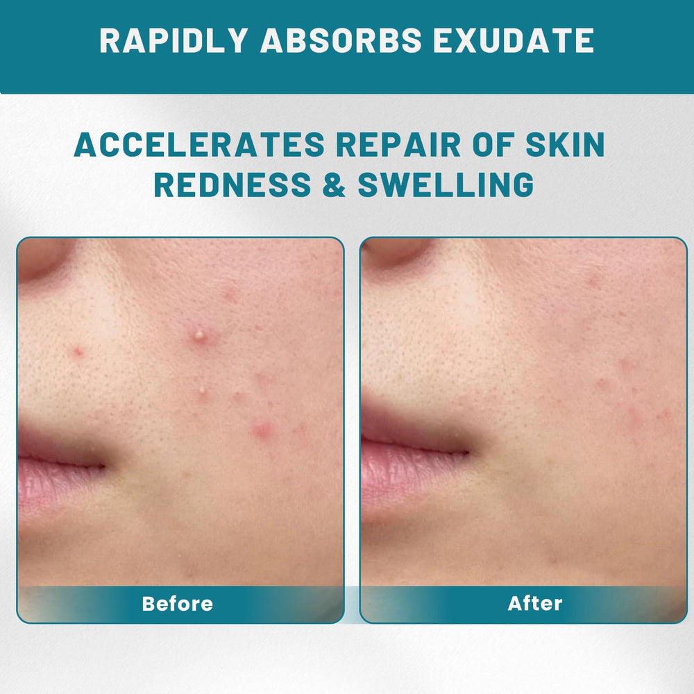 CUKWUYBY daily acne treatment patches support a clearer look.