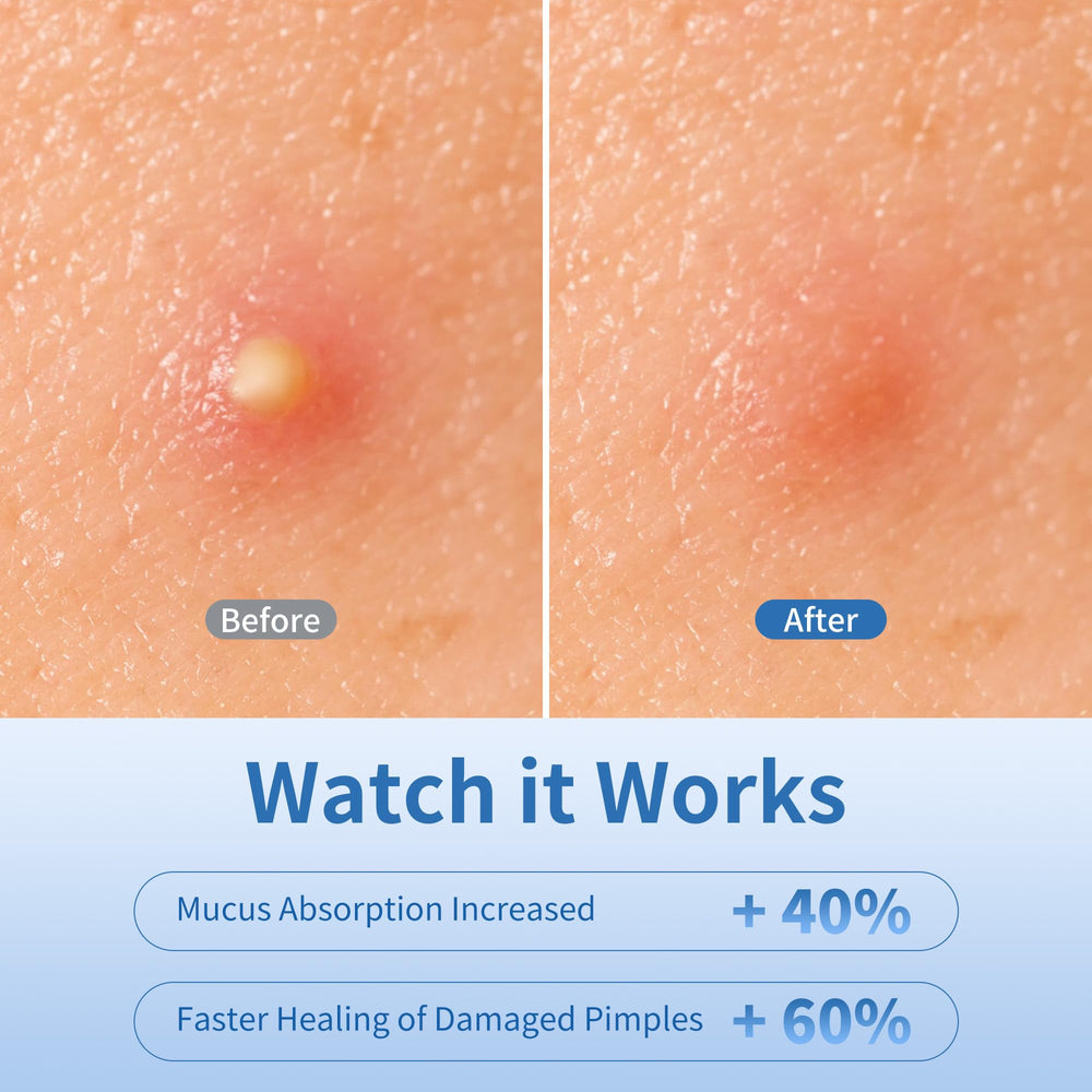 Daolyo patches with tea tree, salicylic acid, calendula nourish while covering