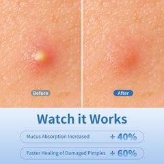 Daolyo patches with tea tree, salicylic acid, calendula nourish while covering