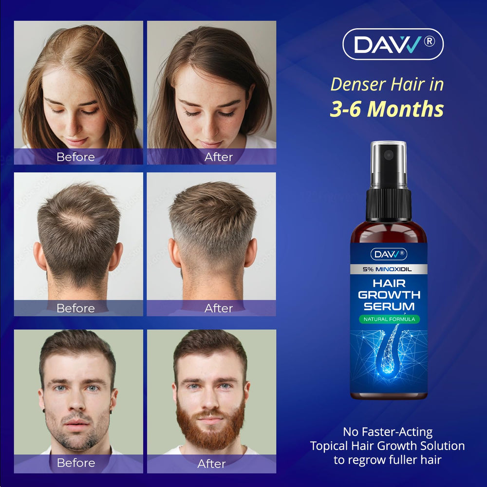 DAVV Minoxidil application on dry hair for clean use.