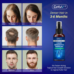 DAVV Minoxidil application on dry hair for clean use.
