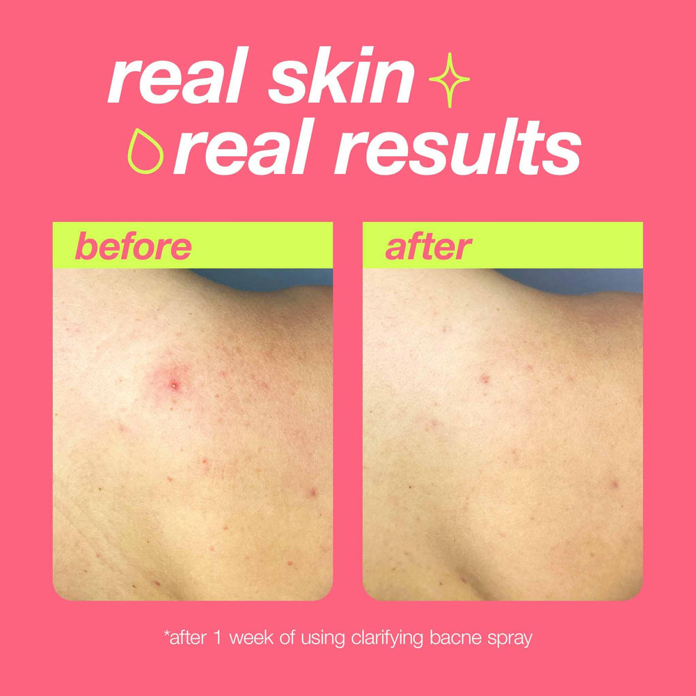 Dermalogica Clear Start salicylic acid exfoliation action unclogging pores.