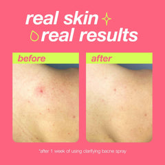 Dermalogica Clear Start salicylic acid exfoliation action unclogging pores.