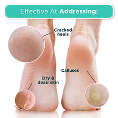 DERMORA Foot Peel Mask peeling process preview around 6–11 days.