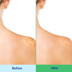Differin Acne-Clearing Body Wash with 2% salicylic acid unclogs pores on the chest and shoulders