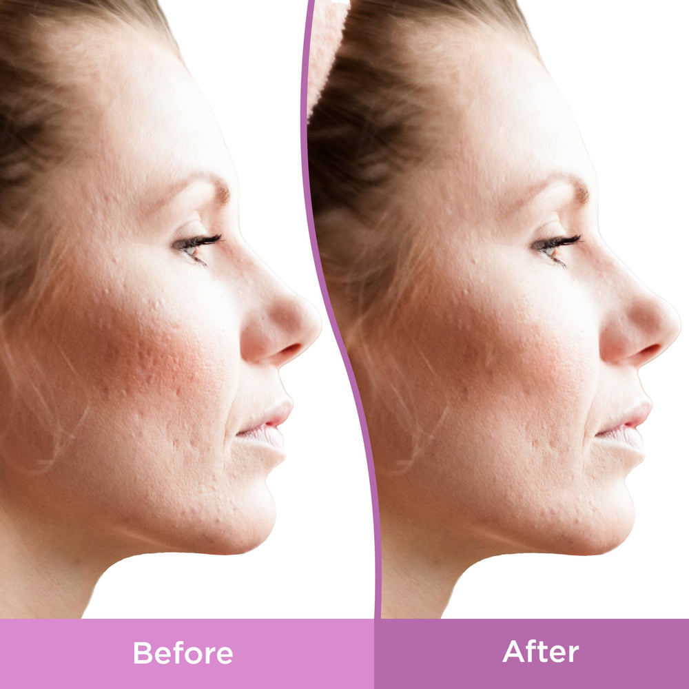 Bakuchiol-rich formula highlighted for surface turnover in Differin gel
