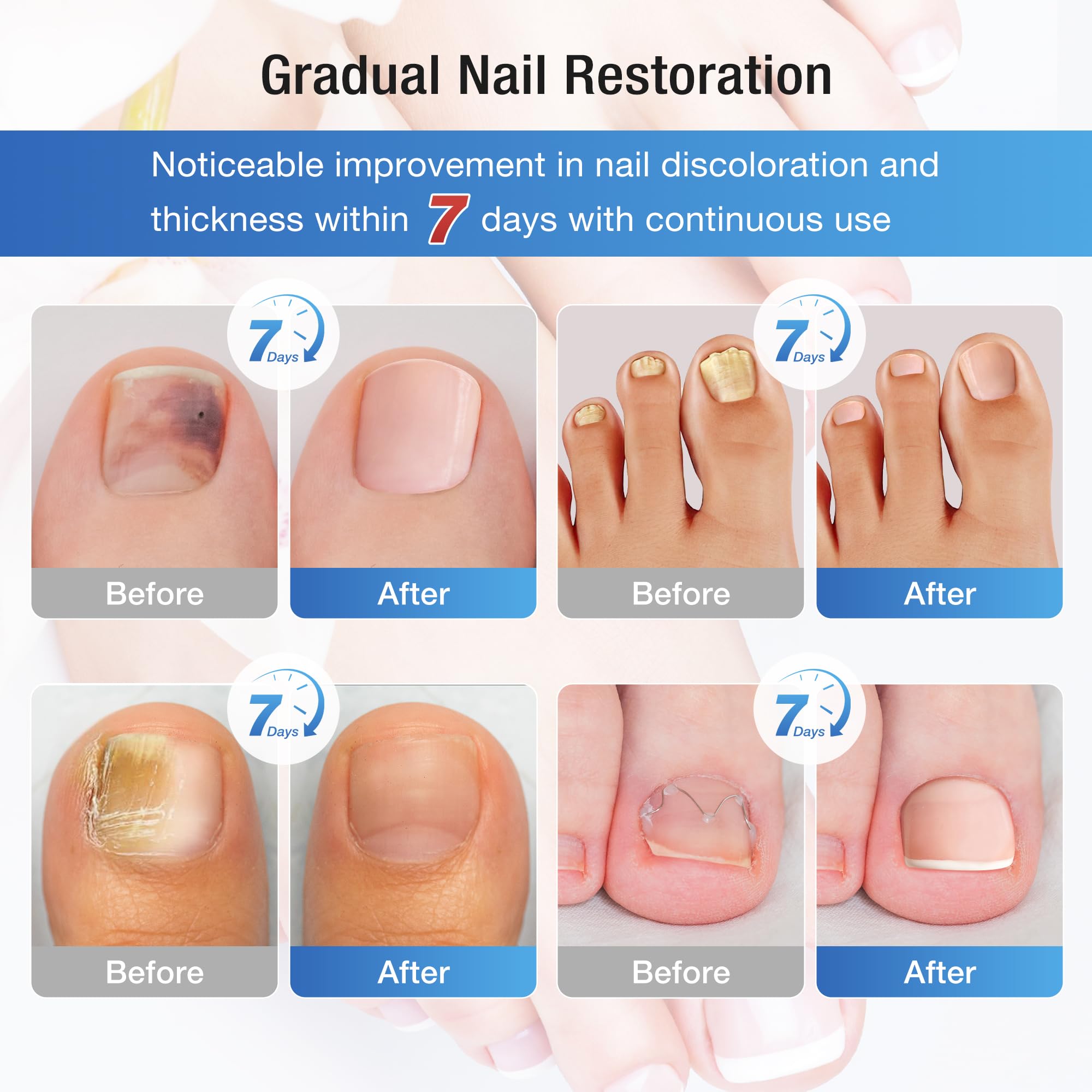 DR.RAPID breathable fungal nail patches pack for overnight care.
