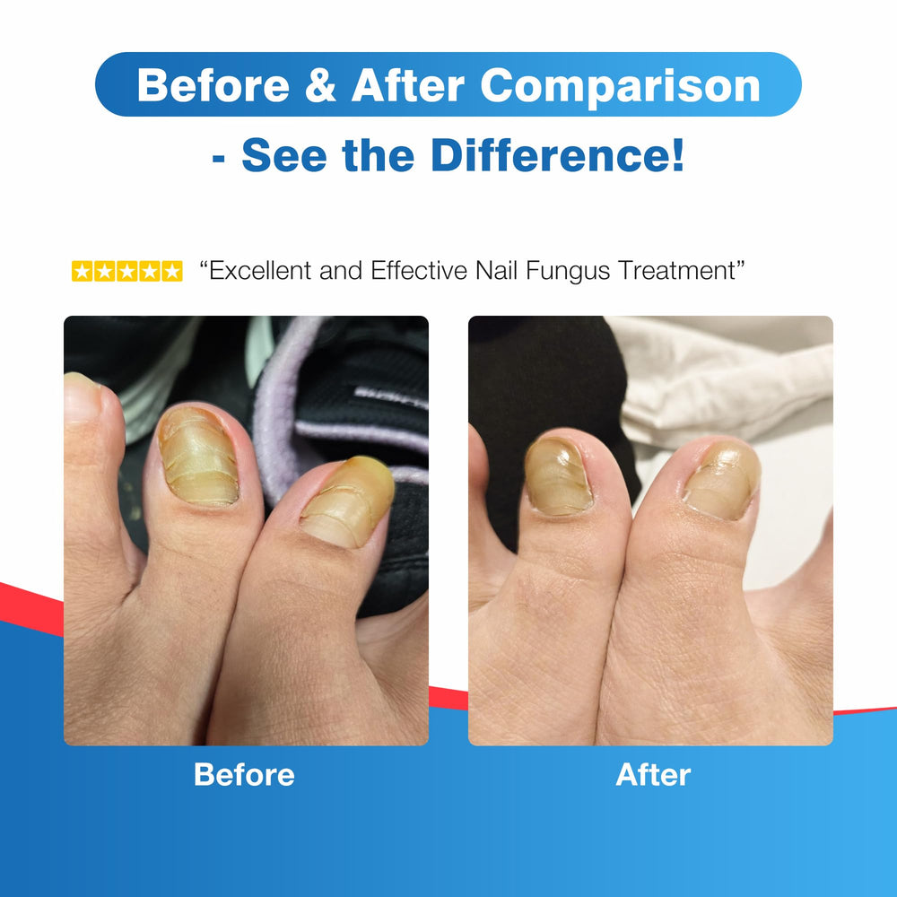 DR.RAPID nail repair pen supporting nail strength while addressing fungus