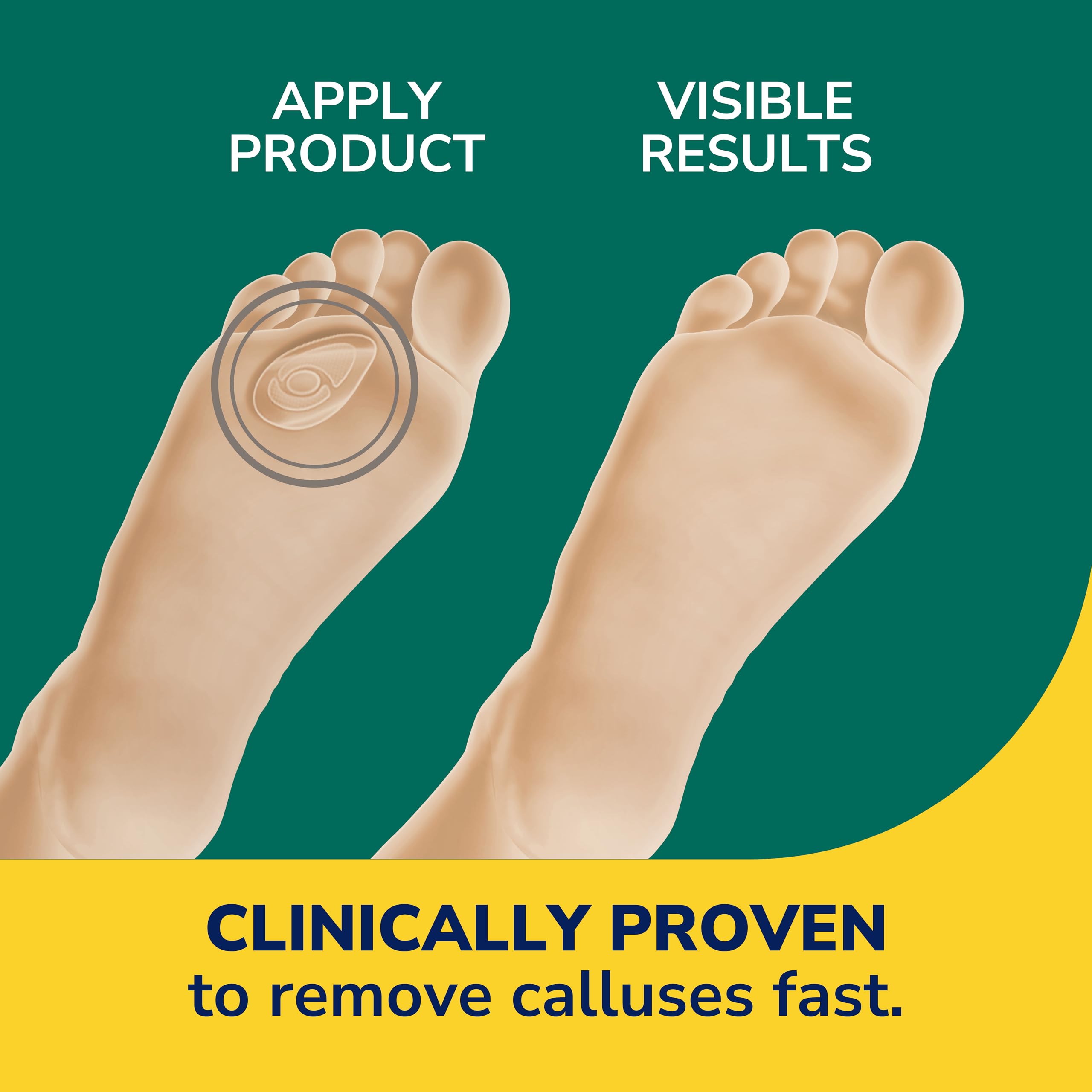 Discs on skin hint at immediate comfort from shoe pressure