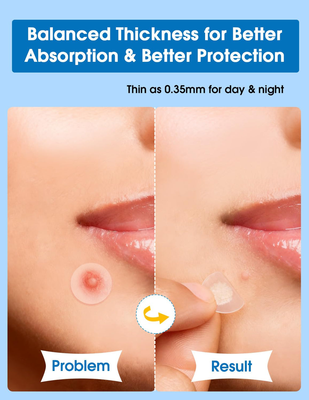 Dr. Zitacne large 11mm patch for bigger blemishes and irritation protection