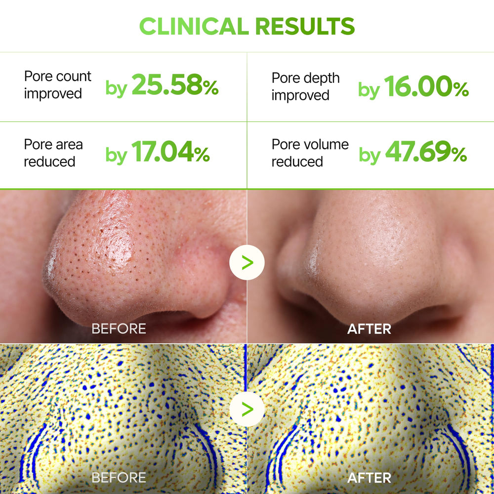 Close-up of pores before treatment with Dr.Melaxin CACTOX