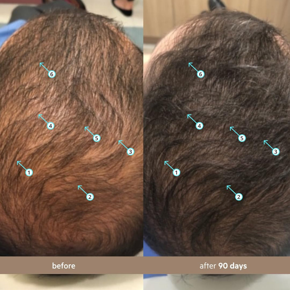 DS Laboratories Spectral Men’s Hair Density Serum applied to the scalp for fuller look