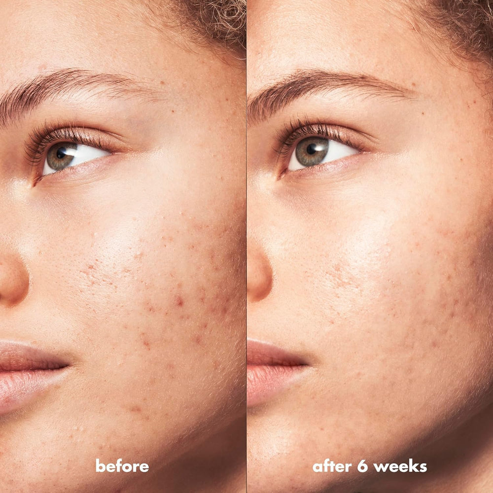 e.l.f. Skin Blemish Breakthrough fragrance-free formula suitable for sensitive skin.