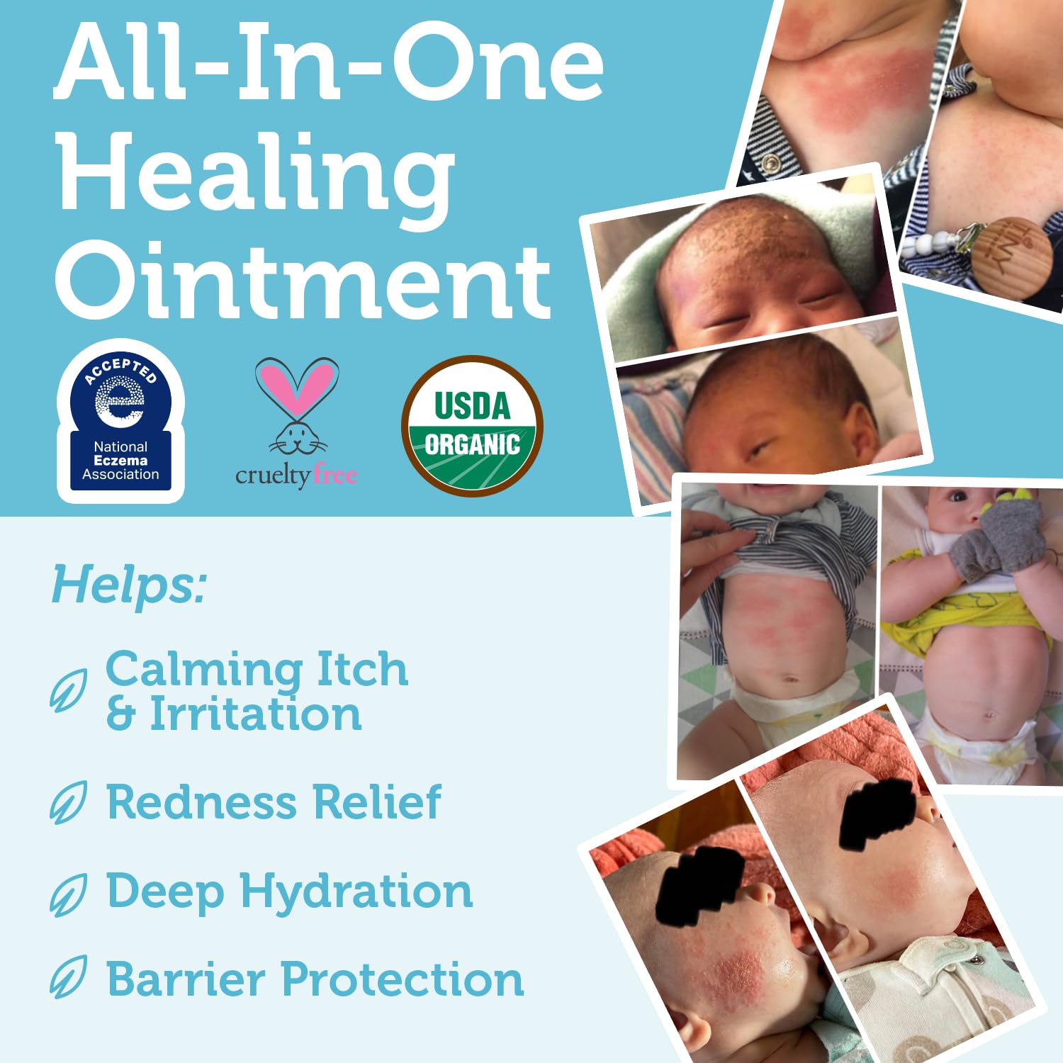 Era Organics Healing Ointment for hives supports gentle skin care