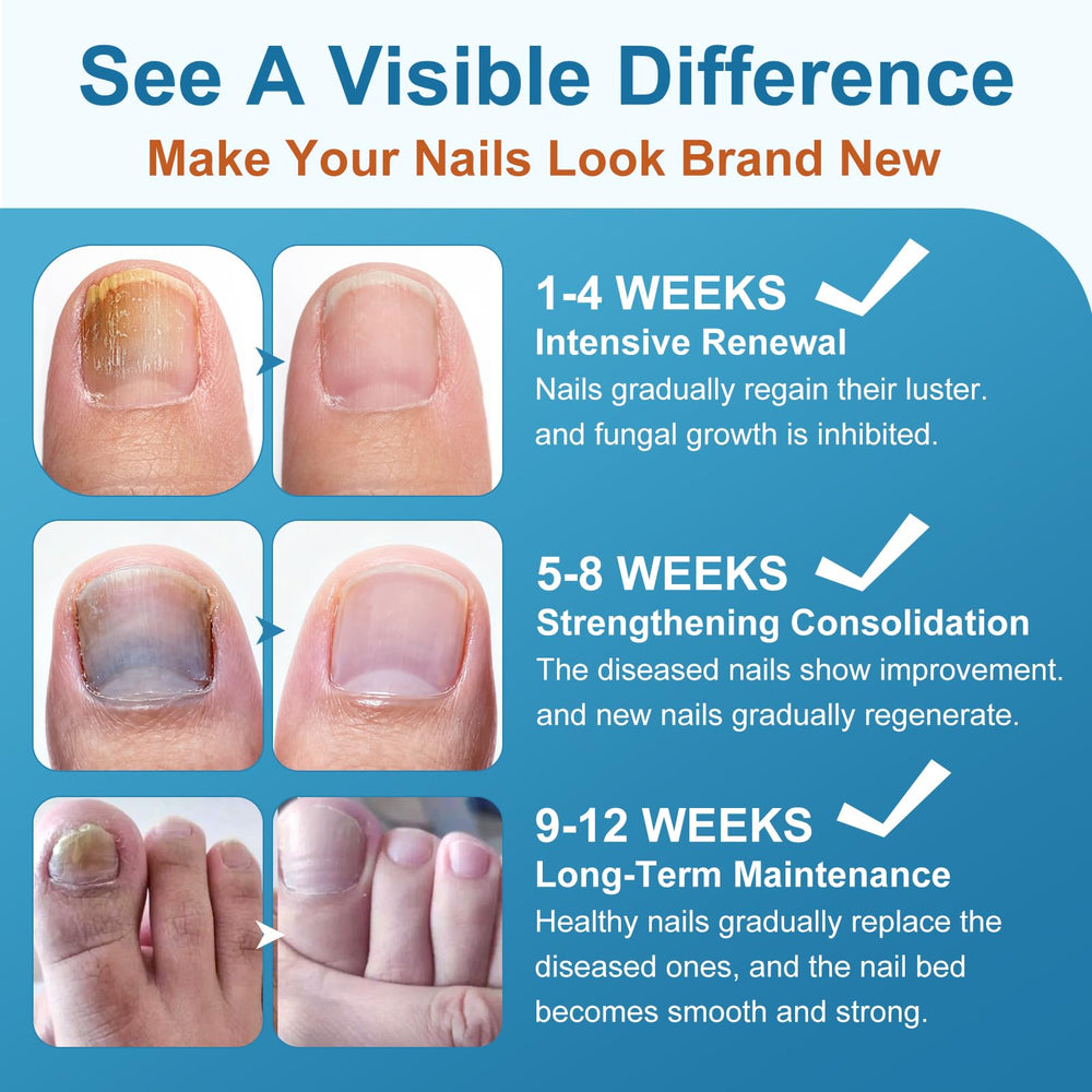 Application on a toenail with sandals-ready appearance.