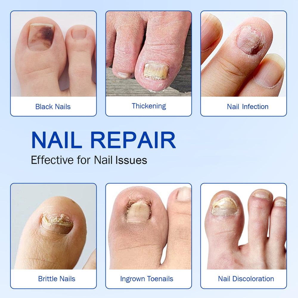 Night-time application of Fanshi patches on toenails during sleep.