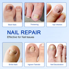 Night-time application of Fanshi patches on toenails during sleep.