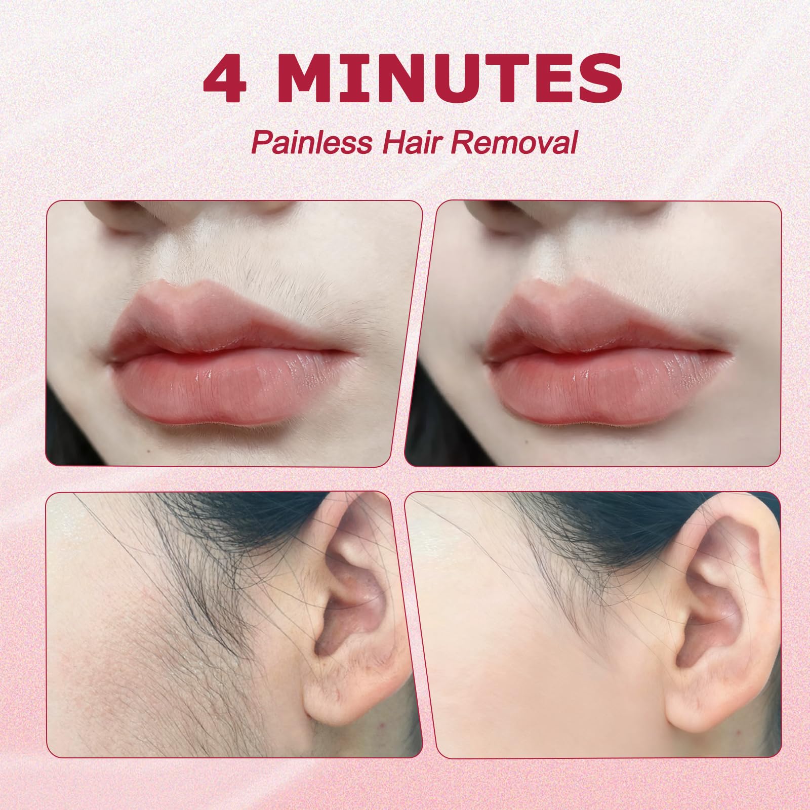 FCBSDAW upper lip area during treatment for painless fuzz removal
