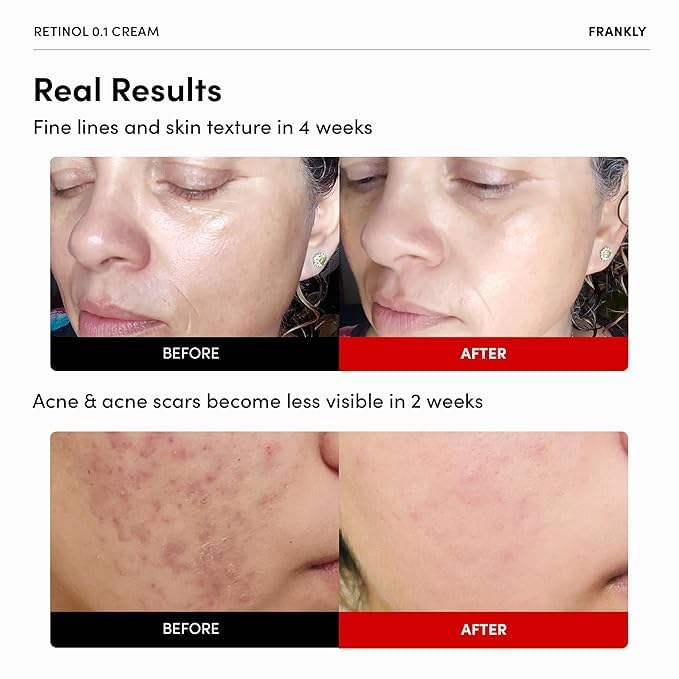 FRANKLY retinol applied to skin showing smoothing potential