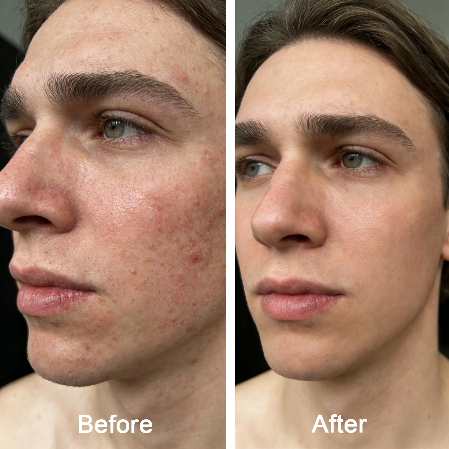 Generic Acne Balm with arnica and rosehip nourishes and soothes skin