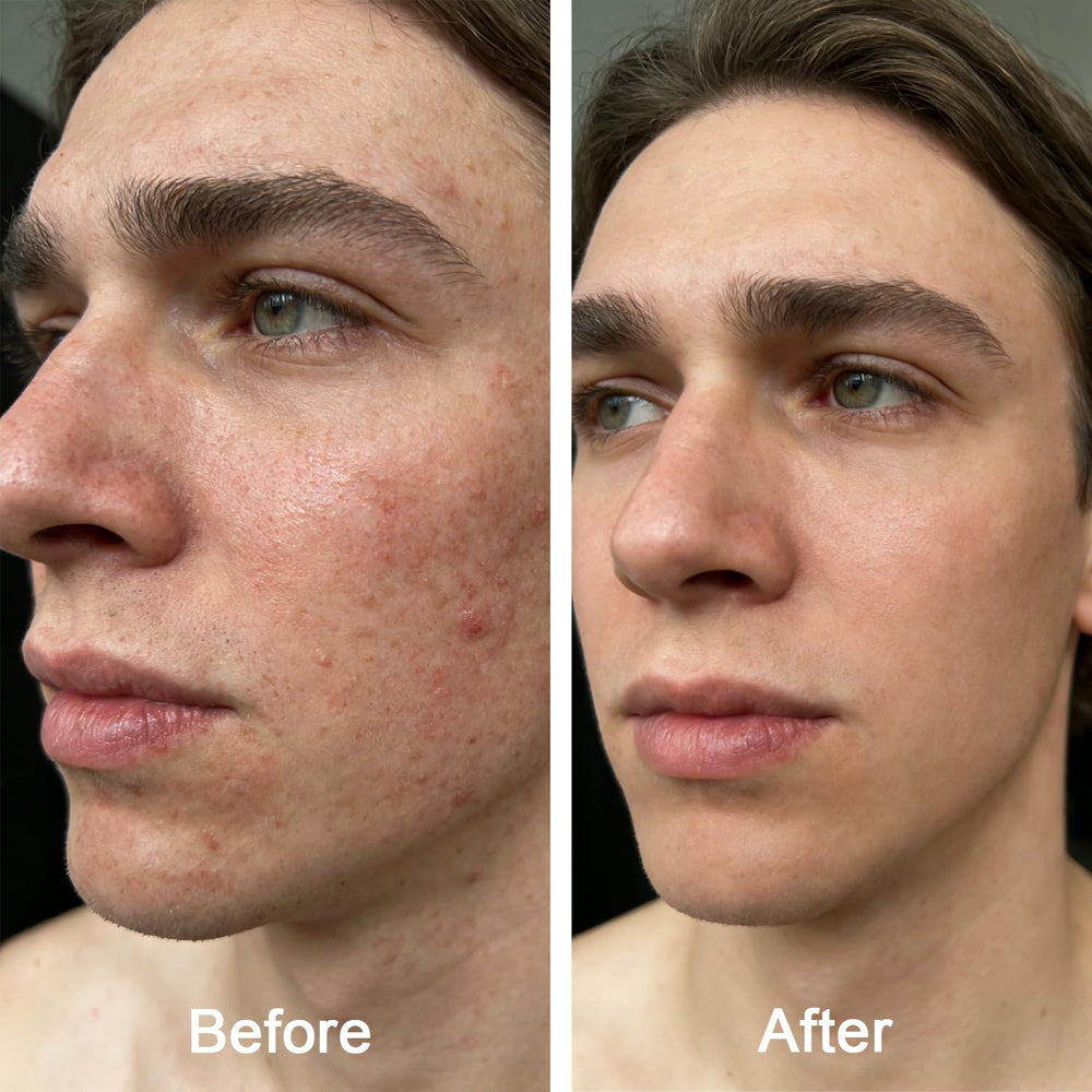 Generic Acne Balm with arnica and rosehip nourishes and soothes skin
