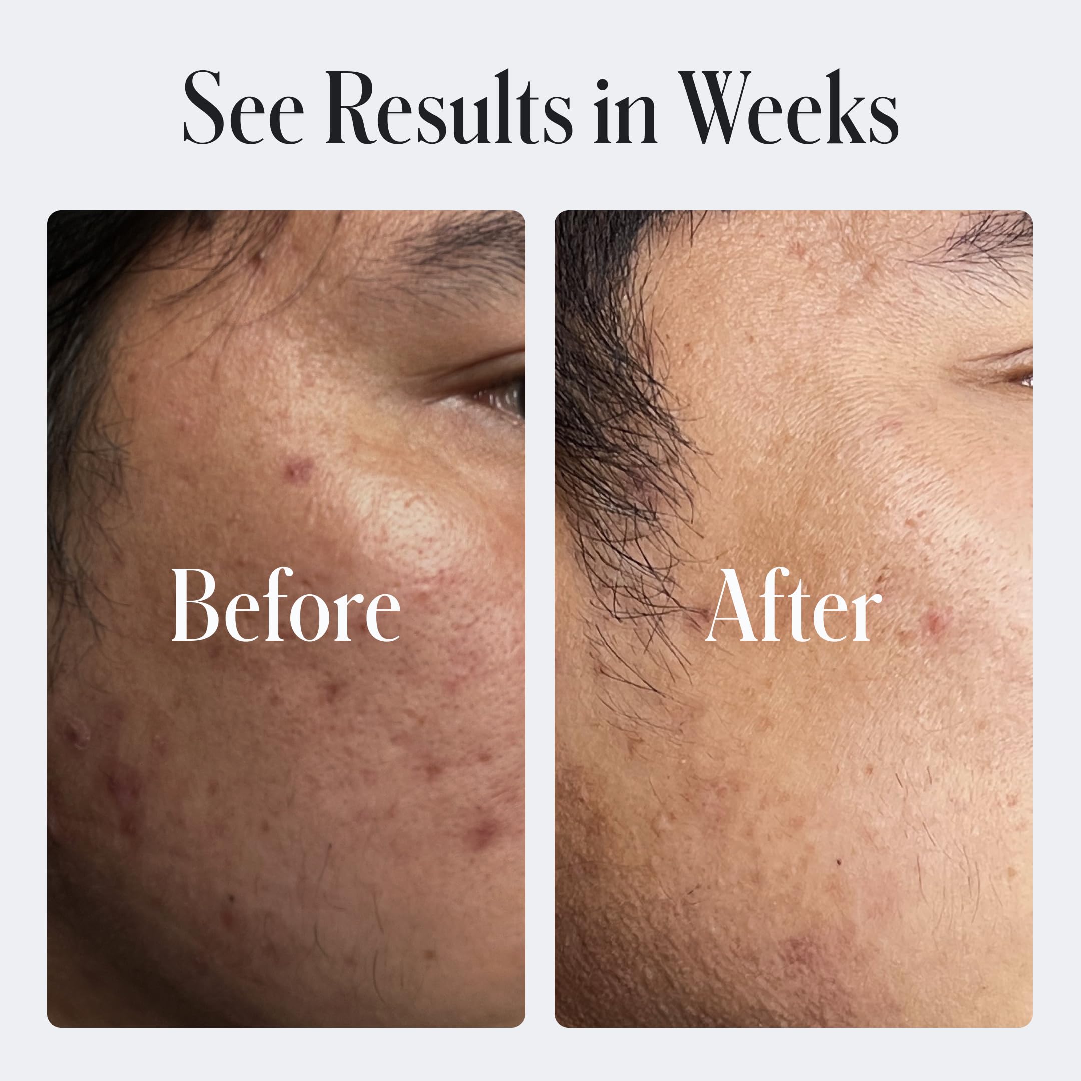 Geologie Clear Skin Face Cream SPF 15 application demonstrates daily sun protection.