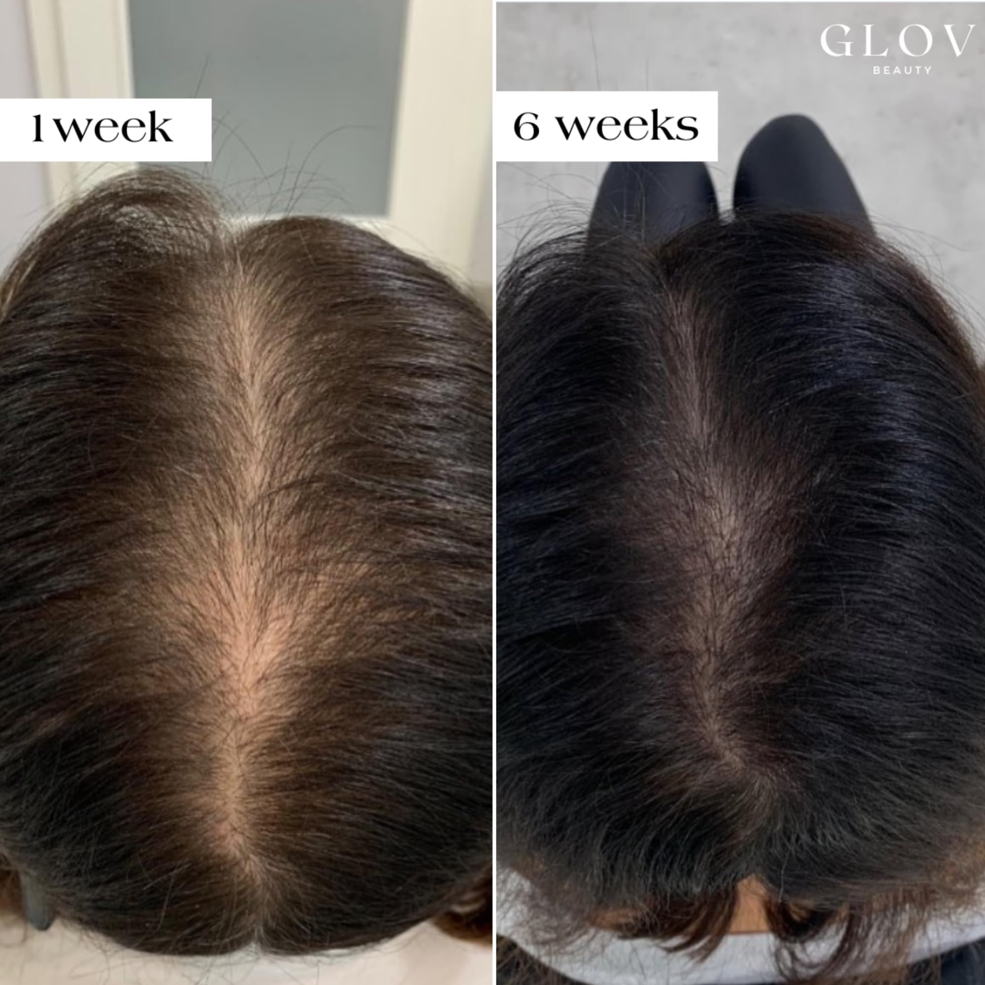 Glov Beauty gold derma stamp head demonstrating precise micro-stimulation.