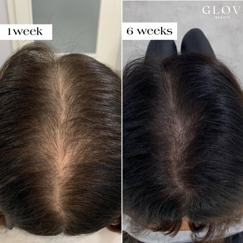 Glov Beauty gold derma stamp head demonstrating precise micro-stimulation.