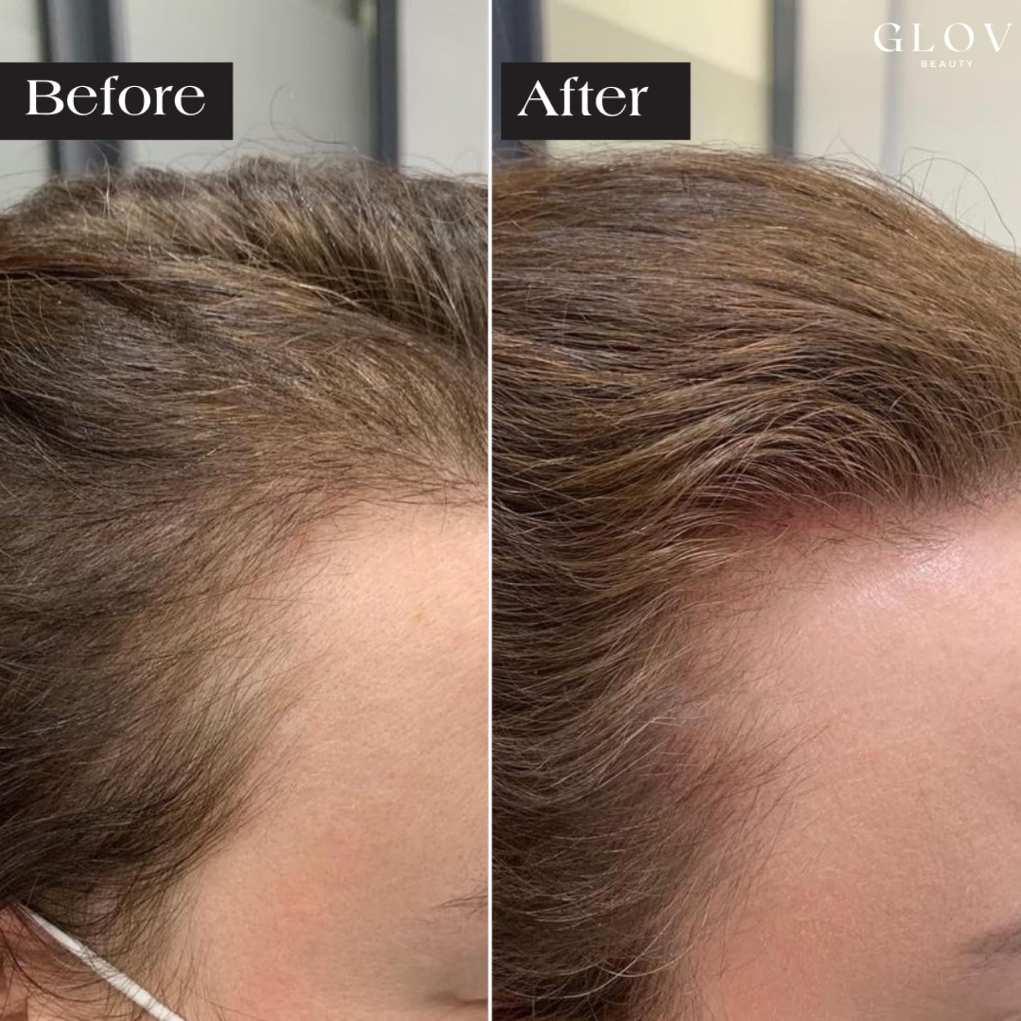 Glov Beauty sterile stamp heads ensure a hygienic single-use session.