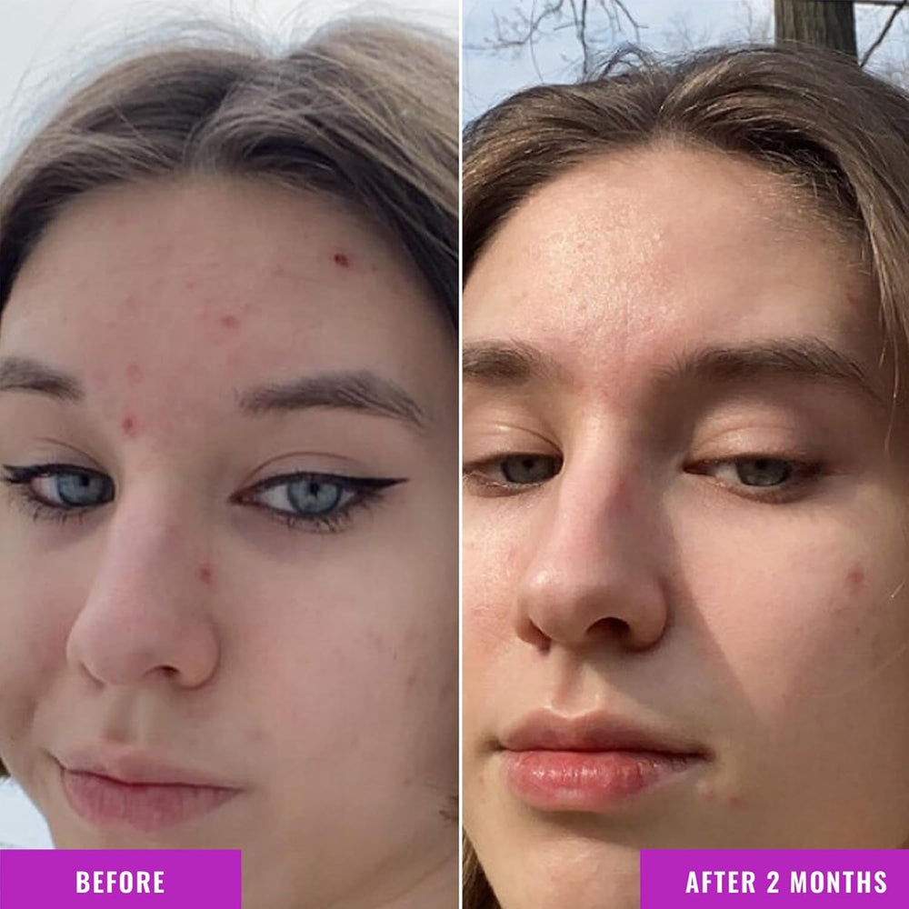 Good Molecules Niacinamide Serum Pack 2 applied to the face for even tone.